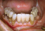 Figure 2A  Transition of the dentate patient to the edentulous state through immediate extraction of teeth, placement of dental implants, and immediate load with an interim fixed restoration.