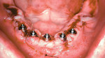 Figure 2B  Transition of the dentate patient to the edentulous state through immediate extraction of teeth, placement of dental implants, and immediate load with an interim fixed restoration.