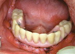 Figure 2C  Transition of the dentate patient to the edentulous state through immediate extraction of teeth, placement of dental implants, and immediate load with an interim fixed restoration.