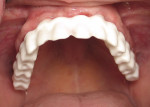 Figure 3A  Zirconia framework with porcelain veneer can be fabricated as a cement-retained or screw-retained prosthesis. The junction of the prosthesis and the gingiva needs to be hidden well above the smile line for an optimal esthetic result.