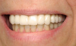 Figure 3C  Zirconia framework with porcelain veneer can be fabricated as a cement-retained or screw-retained prosthesis. The junction of the prosthesis and the gingiva needs to be hidden well above the smile line for an optimal esthetic result.