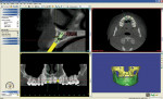 Figure 1  A snapshot of a screen from the Simplant® software program (Materialise Dental NV, Leuven, Belgium). The upper right section shows an axial cut superior to the crestal bone in the maxillary arch. The yellow line through the teeth is the