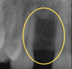 Figure 2  Periapical radiograph of site No. 7. The bone levels appear to be favorable for implant placement.