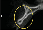 Figure 3  A perpendicular reslice of the same site seen on i-CAT Vision (Imaging Sciences International,Hatfield, PA). The lack of bone volume is readily apparent.