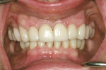 Figure 5  Patient with provisional restorations.