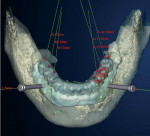 Figure 7  A snapshot from the Procera® software (Nobel Biocare) showing bone, fixation pins, scanning appliance, and surgical sleeves for a template that will guide the implant fixtures into their ideal position.