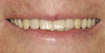 Figure 13  Approved maxillary denture.