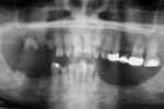 Figure 17  Panoramic view of maxillary and mandibular prostheses.