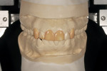 Figure 1  The basic diagnostic wax-up aids in developing an overall game plan for the restorative procedures.