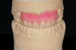 Figure 3  The case presentation wax-up is generally requested to show the patient the end result of the personalized treatment plan.