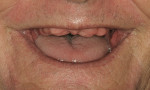 Figure 33  Edentulous maxilla of same patient in Figure 32 displaying elaborate amount of residual alveolar ridge on smiling. This patient requires surgical intervention and conversion to another class for optimal treatment with a fixed prosthesis.