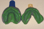 Figure 2  Accurate set of PVC impressions that include all anatomic structures. Note extension into vestibule.