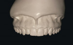 Figure 3a  Stone models reproducing detail from the PVC impressions. Note the occlusal surface and soft tissue detail.