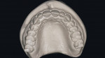 Figure 3b  Stone models reproducing detail from the PVC impressions. Note the occlusal surface and soft tissue detail.