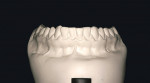 Figure 3d  Stone models reproducing detail from the PVC impressions. Note the occlusal surface and soft tissue detail.