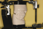 Figure 7b  An accurately mounted set of face-bow articulated centric relation-mounted study models ready for the examination, treatment planning, and restorative phases of treatment (pin removed for viewing).