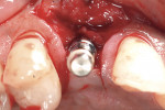 Figure 6  Implant carrier device in place showing a restoratively driven position by use of the surgical guide template. Note the papillary-sparing incisions to prevent any interproximal periodontal attachment loss and recession. The buccal contours
