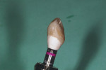 Figure 12  Provisional restoration reflecting a flat buccal emergence profile. A regular connection temporary meso abutment becomes the subgingival area attached to an appropriate canine crown former.