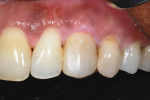 Figure 15  Soft tissues at 3 months after initial provisionalization of tooth No. 11. The subgingival contours had been developed further to better support the soft tissues buccally and interproximally. Compare with Figure 14.