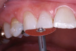 Figure 2  Maxillary incisal edges reshaped with disc.