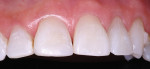 Figure 5  Completed esthetic result.