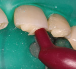 Figure 10  Placement of composite resin into intradentin tooth preparations.