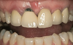 Figure 2  Anterior ceramo-metal crowns displaying the less esthetic opacity that is sometimes evident in metal-substructure restorations.