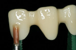 Figure 8  A shade base stain is applied to the zirconia framework and fired prior to application of the veneering porcelain.