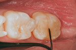 Figure 7  The occlusal morphology of the mandibular second molar is sculpted in nano–micro hybrid composite (Venus Diamond).