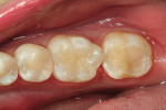 Figure 14  An occlusal view of the completed restorations.