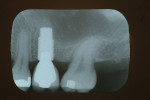 Figure 2  X-ray showing implant in place.