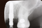 Figure 5  X-ray of implant in place, restored with a provisional abutment.