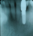 Figure 8  Implant with high-level microthreads in place.