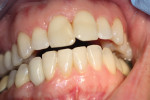 Figure 9: Final crown restoration for implant replacement after 2 years.