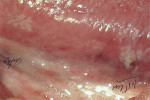 Figure 4  These white macules on the lateral border of the tongue (designated anterior and posterior) were histologically diagnosed as hyperplastic candidiasis. (Figure courtesy of Shibly Malouf, DDS, Somerville, Massachusetts.)