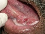 Figure 5  This erythroleukoplakia occurring on the mucosa overlying Wharton’s duct was biopsied and histologically diagnosed as a mild epithelial dysplasia. A second biopsy from a different site was recommended because of the high level of clinical