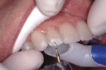 Figure 3  The provisionals are roughened for the addition of composite, which will increase their length.