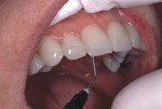 Figure 5  Low-viscosity composite is applied to previously completed provisionals.