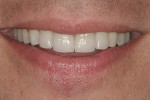 Figure 11  This image exhibits conservative, leucite-reinforced porcelaina restorations on teeth Nos. 7 through 10.