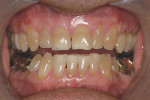 Figure 15  Retracted image shows the high degree of chroma in the patient’ss natural dentition
