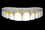 Figure 17  This view illustrates the initial placement of honey yellow coloration at the gingival thirds of the provisionals.
