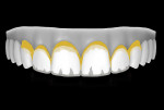 Figure 20  This illustration shows the placement of a diluted grey or violet tint to mimic incisal translucency.
