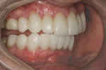 Figure 25  Outside-in movement of the mandible against the maxillary arch is used to verify gnathologic harmony with the morphology of the provisionals.