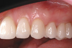 Figure 4  The tissue health visible around these all-ceramic restorations (from the central incisors to the first molar), which have been in the mouth after 10 years, is in large part a result of perfectly fitting provisionals that facilitated a bloo