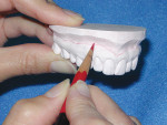Figure 5  A precise study cast that captures all of the soft tissue anatomy is required for best results with the indirect provisional technique.