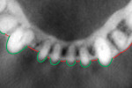 Figure 2  Axial section through this same tooth No. 22 with minimal facial bone.