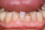 Figure 6  In this full-mouth case, a decision was made to use mandibularcentral incisors that were 7.0 mm long. Once the incisor was rebuilt to thedesired length, the lingual contour of the maxillary antagonist was rebuiltin its virgin form. By havin