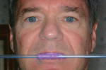 Figure 7  The straw reflects the horizontal plane compared to the pupillary line while the patient is standing. A canted incisal plane seriously compromises full-arch cosmetic cases