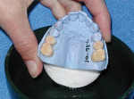 Figure 11  When using alginate to duplicate a wax-up, the model must be totally hydrated.