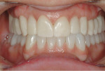Figure 23  In this case, the occlusion and the envelope of function have been altered dramatically. In the after photograph the mandibular all-ceramic restorations have been cemented for five weeks and the maxillary provisionals have been in place fo